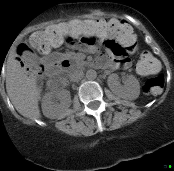 File:Obstructed infected horseshoe kidney (Radiopaedia 18116-17898 non-contrast 7).jpg