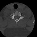 Occipital condyle fracture (Radiopaedia 31755-32691 Axial bone window 67).jpg