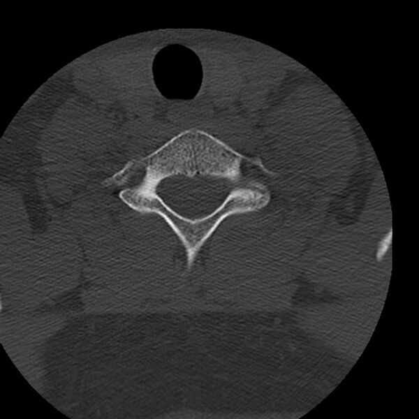File:Occipital condyle fracture (Radiopaedia 31755-32691 Axial bone window 67).jpg
