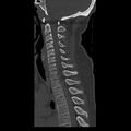 Occipital condyle fracture (Radiopaedia 31755-32691 Sagittal bone window 21).jpg