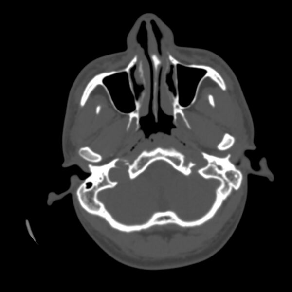 File:Occipital spur - asymptomatic (Radiopaedia 87753-104201 Axial bone window 15).jpg