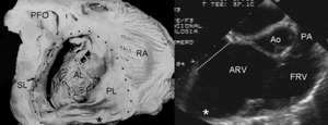 Ebstein's anomaly shows dilatation at atrioventricular junction and aneurysmal fibrous sac asterisk (and echocardiogram asterisk)