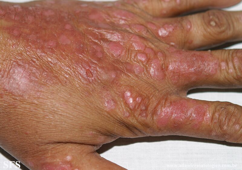 File:Psoriasis (Dermatology Atlas 124).jpg