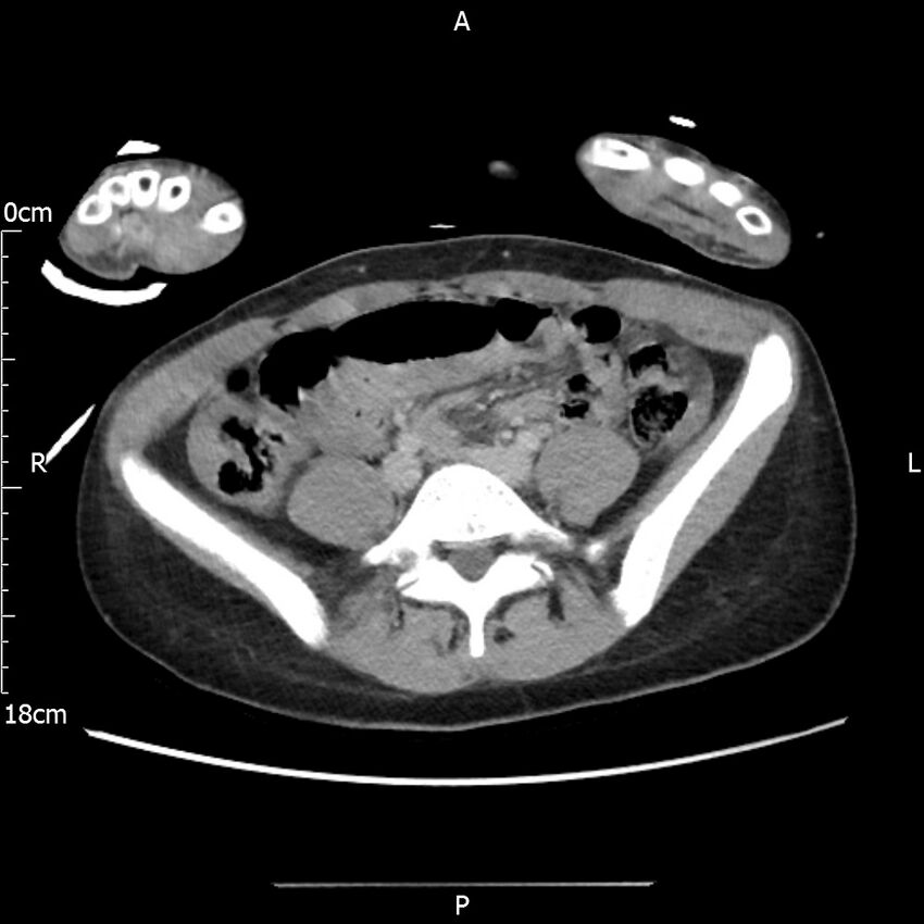 AAST grade IV kidney injury with CEUS follow-up (Radiopaedia 72353-82877 Axial C+ portal venous phase 49).jpg