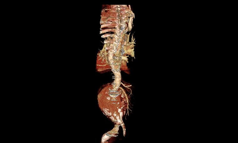 File:Abdominal aortic aneurysm- extremely large, ruptured (Radiopaedia 19882-19921 3D 14).jpg