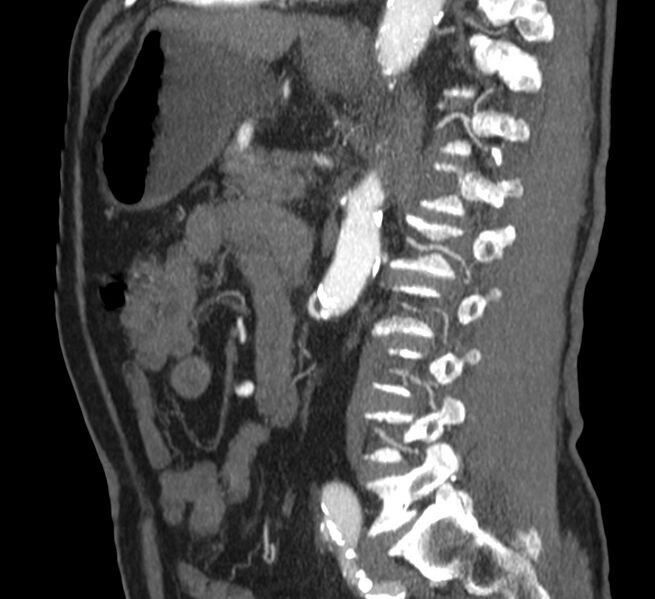 File:Abdominal aortic aneurysm (Radiopaedia 22421-22458 D 26).jpg