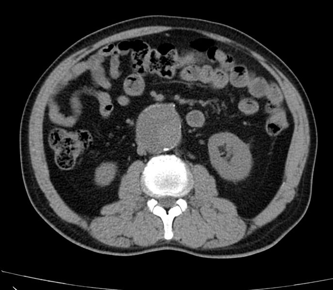 File:Abdominal aortic aneurysm (Radiopaedia 22421-22458 non-contrast 26).jpg