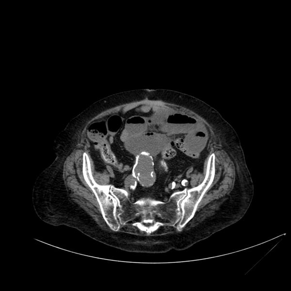 File:Abdominal aortic aneurysm - impending rupture (Radiopaedia 19233-19246 Axial non-contrast 96).jpg