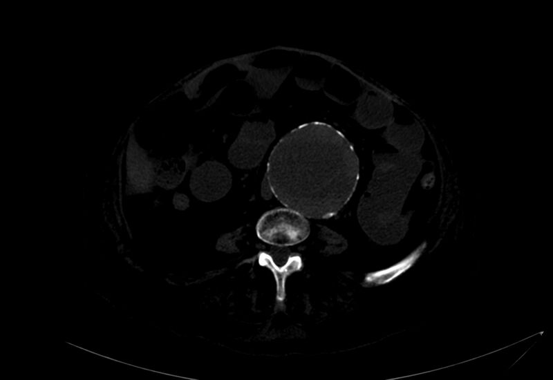 File:Abdominal aortic aneurysm - impending rupture (Radiopaedia 19233-19246 B 25).jpg