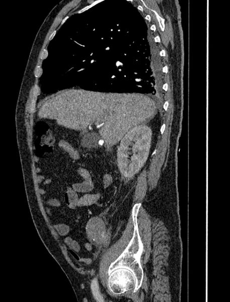 File:Abdominal aortic aneurysm rupture (Radiopaedia 54179-60362 Sagittal C+ arterial phase 11).jpg