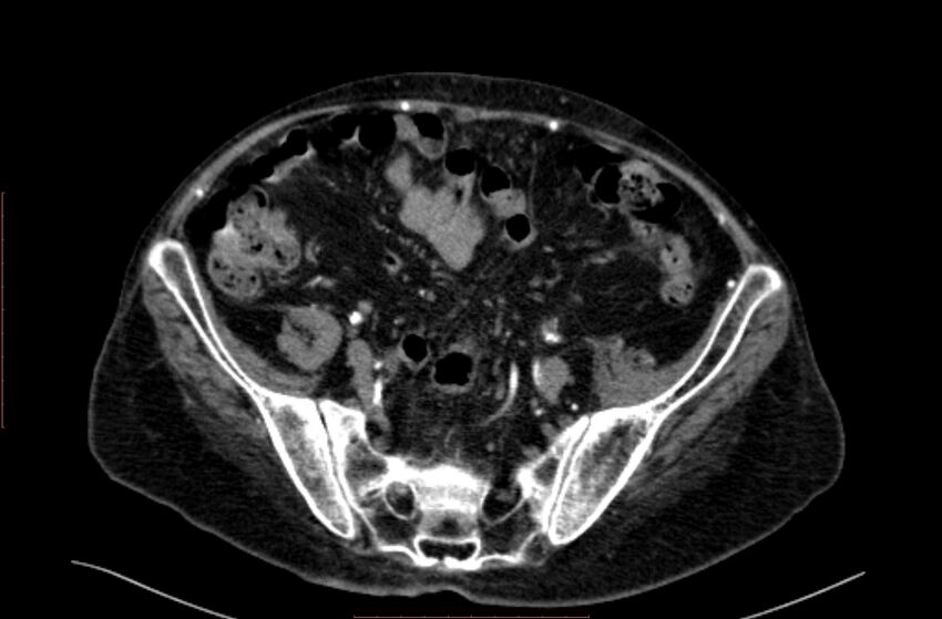 Abdominal aortic interposition tube graft and aneurysm thrombosis (Radiopaedia 71438-81857 Axial C+ arterial phase 169).jpg