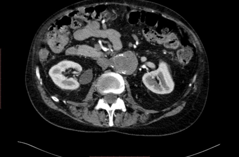 File:Abdominal aortic interposition tube graft and aneurysm thrombosis (Radiopaedia 71438-81857 Axial C+ arterial phase 57).jpg