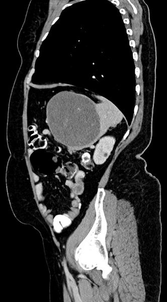 File:Abdominal hydatid disease (Radiopaedia 68223-77737 Sagittal C+ portal venous phase 17).jpg