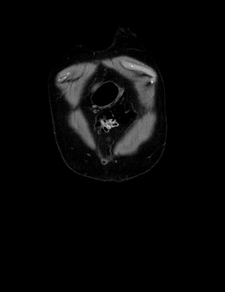 File:Abdominal lymphoma - with sandwich sign (Radiopaedia 53486-59492 C+ portal venous phase 56).jpg