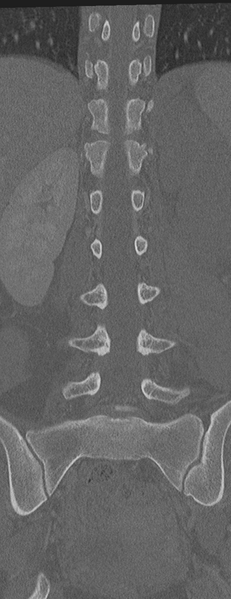 File:Abdominal multi-trauma - devascularised kidney and liver, spleen and pancreatic lacerations (Radiopaedia 34984-36486 Coronal bone window 40).png