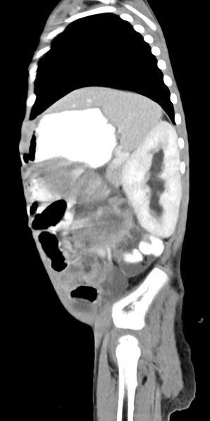 File:Abdominopelvic rhabdomyosarcoma (Radiopaedia 78356-90984 Sagittal C+ portal venous phase 25).jpg