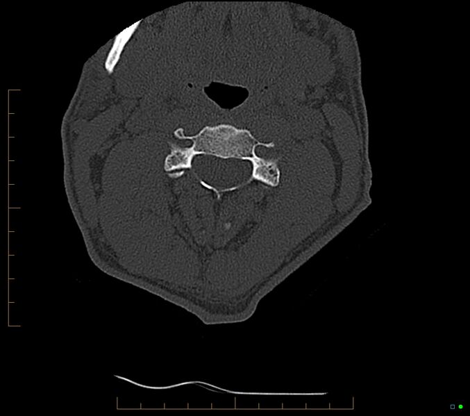 File:Accessory articulation of cervical transverse processes (Radiopaedia 82715-96933 Axial non-contrast 49).jpg