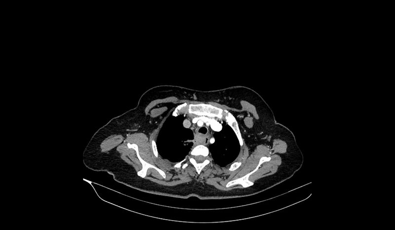 File:Acquired tracheo-esophageal fistula (Radiopaedia 51356-57103 Axial C+ arterial phase 23).jpg