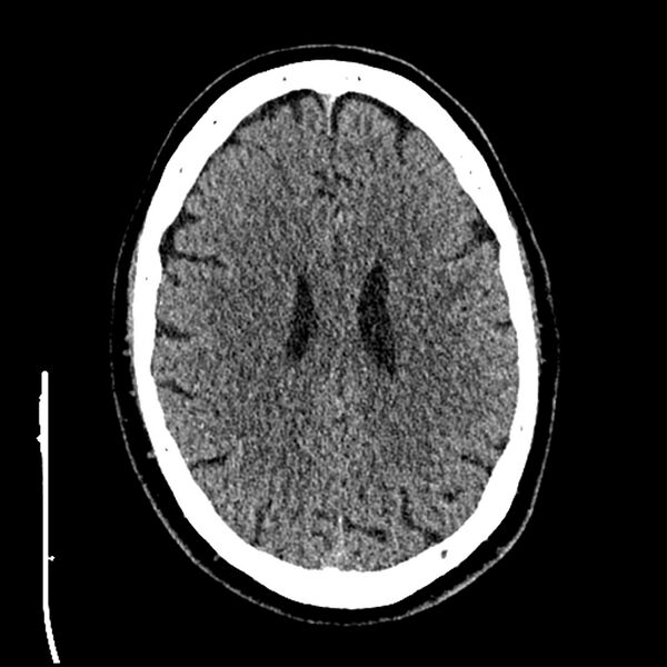 File:Acute A3 occlusion with ACA ischemic penumbra (CT perfusion) (Radiopaedia 72036-82525 Axial non-contrast thins 67).jpg
