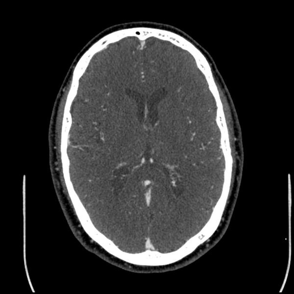 File:Acute A3 occlusion with ACA ischemic penumbra (CT perfusion) (Radiopaedia 72036-82527 Axial C+ arterial phase thins 60).jpg