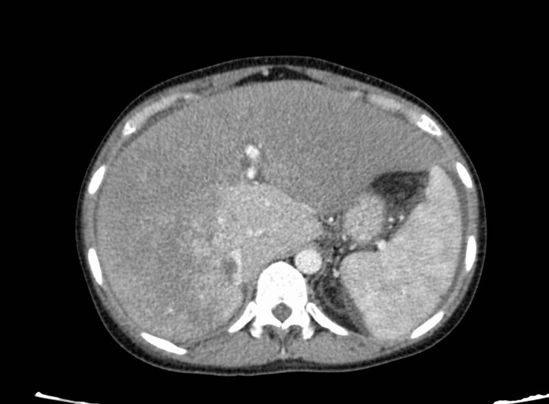 File:Acute Budd-Chiari syndrome (Radiopaedia 60858-68638 Axial C+ portal venous phase 73).jpg