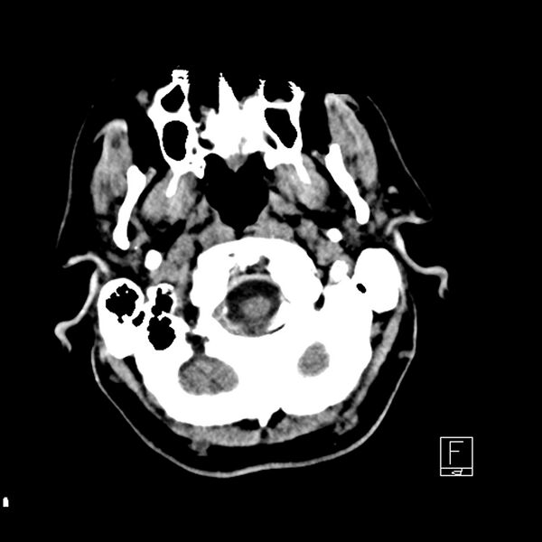 File:Acute ICA ischemic penumbra due to high-grade CCA stenosis (CT perfusion) (Radiopaedia 72038-82529 Axial non-contrast 1).jpg