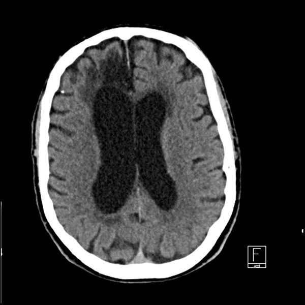 File:Acute ICA ischemic penumbra due to high-grade CCA stenosis (CT perfusion) (Radiopaedia 72038-82529 Axial non-contrast 29).jpg