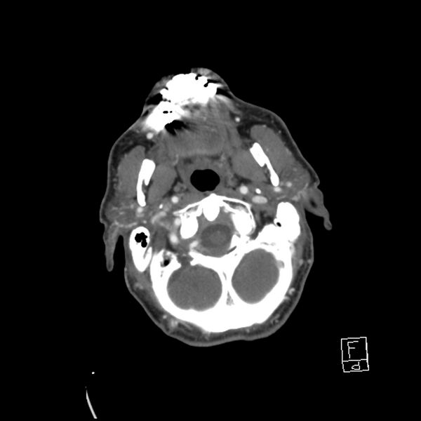 File:Acute ICA ischemic penumbra due to high-grade CCA stenosis (CT perfusion) (Radiopaedia 72038-82530 Axial C+ arterial phase 27).jpg