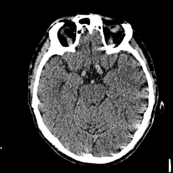 File:Acute P1 occlusion with PCA ischemia penumbra (CT perfusion) (Radiopaedia 72084-82586 Axial non-contrast thins 6).jpg