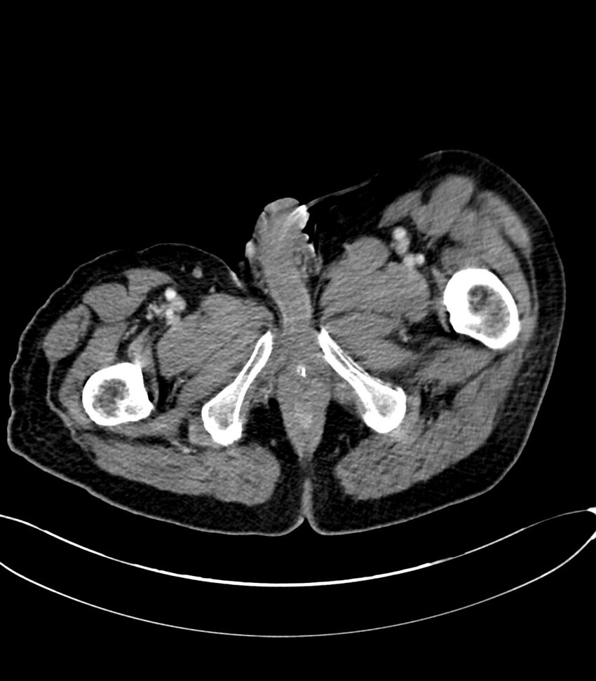 Acute arterial mesenteric ischemia (Radiopaedia 78238-90828 Axial C+ portal venous phase 154).jpg