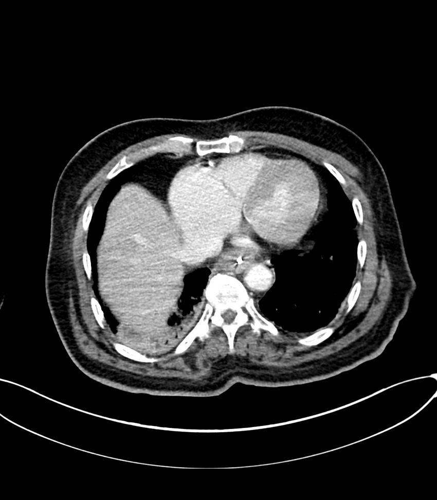 Acute arterial mesenteric ischemia (Radiopaedia 78238-90828 Axial C+ portal venous phase 16).jpg