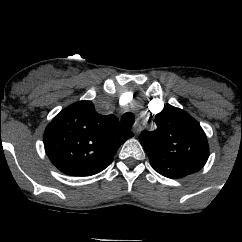 Acute chest syndrome - sickle cell disease (Radiopaedia 42375-45499 Axial C+ CTPA 40).jpg