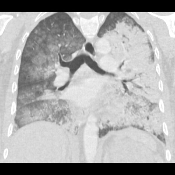 File:Acute diffuse alveolar hemorrhage (Radiopaedia 41323-44158 Coronal lung window 31).jpg