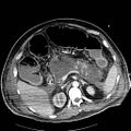Acute pancreatic necrosis (Radiopaedia 13560-18502 Axial C+ portal venous phase 25).jpg