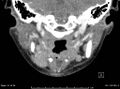 Acute parotitis (Radiopaedia 54123-60294 Coronal C+ arterial phase 10).jpg