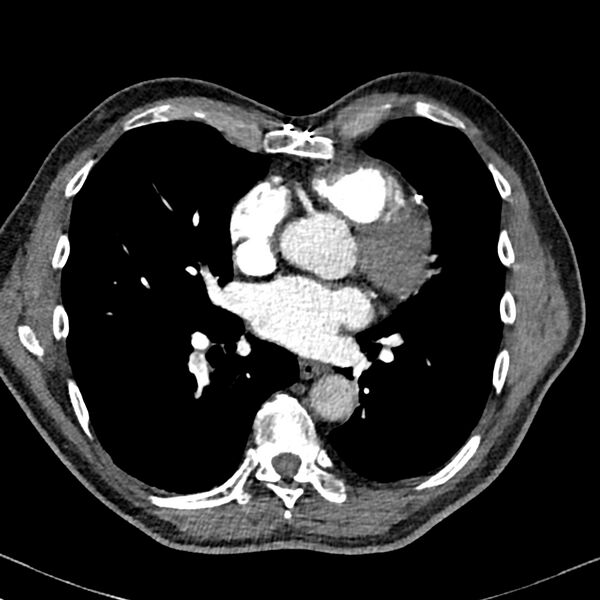 File:Acute pulmonary embolism (Radiopaedia 81677-95570 Axial C+ CTPA 70).jpg