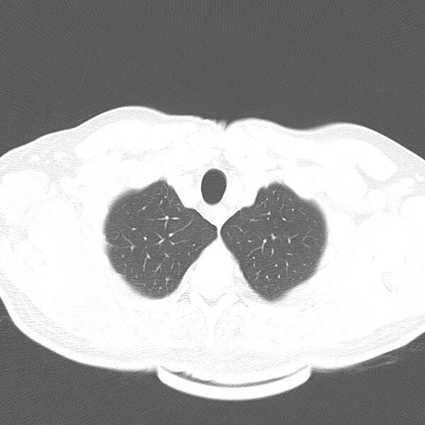 File:Acute pulmonary embolism (Radiopaedia 81677-95570 Axial lung window 5).jpg