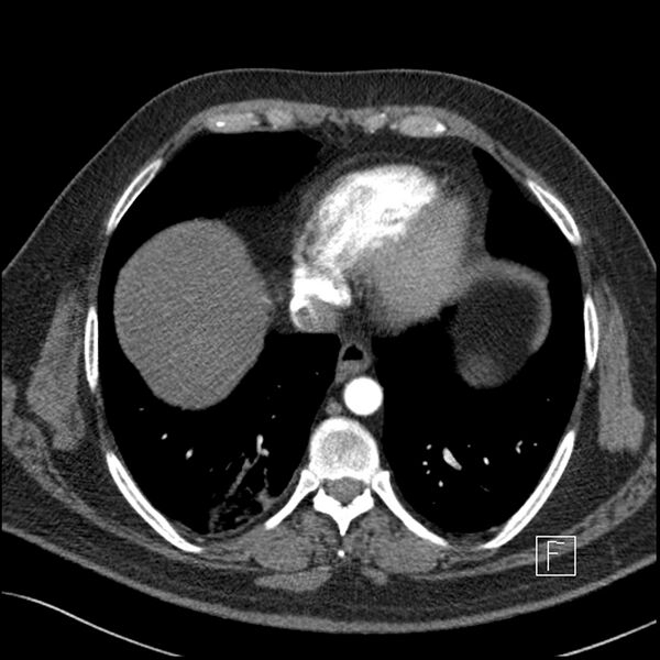 File:Acute pulmonary embolism with pulmonary infarct (Radiopaedia 73062-83768 Axial C+ CTPA 58).jpg