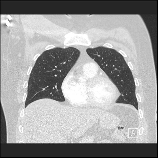 File:Acute pulmonary embolism with pulmonary infarct (Radiopaedia 73062-83768 Coronal lung window 24).jpg