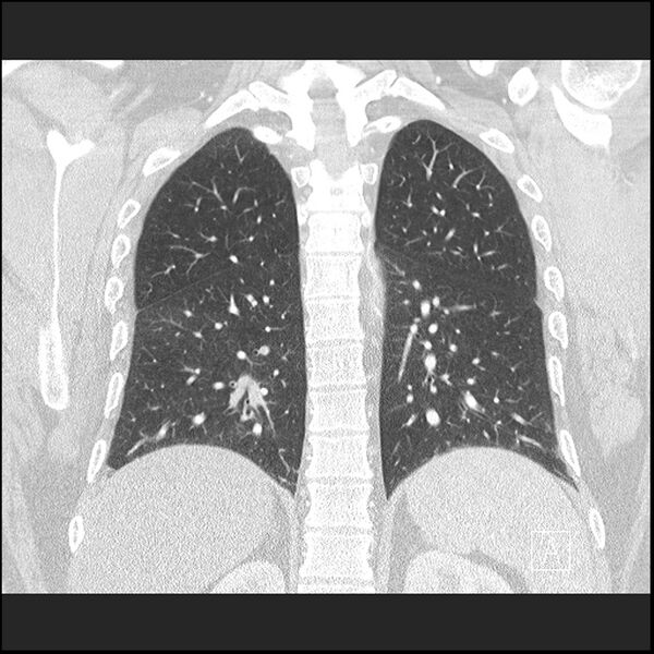 File:Acute pulmonary embolism with pulmonary infarct (Radiopaedia 73062-83768 Coronal lung window 54).jpg