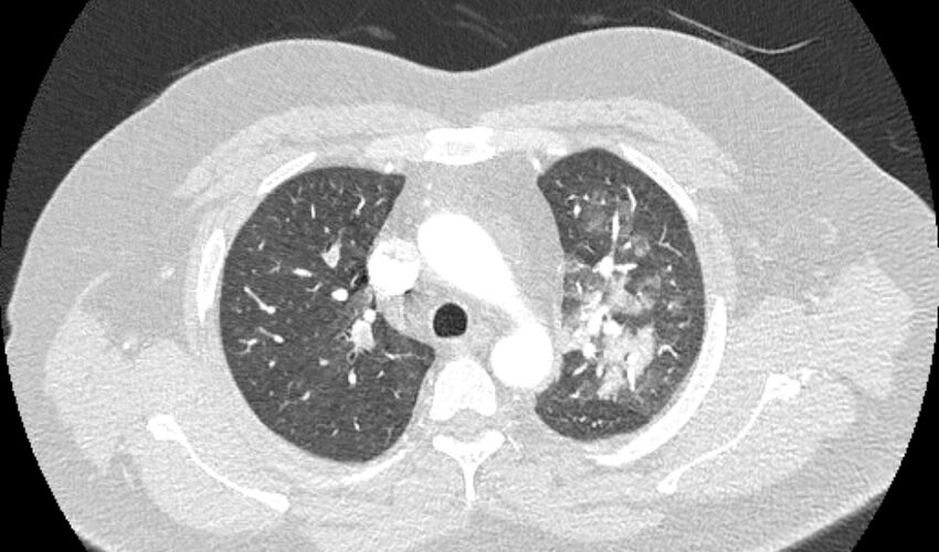 Acute pulmonary embolism with pulmonary infarcts (Radiopaedia 77688-89908 Axial lung window 29).jpg
