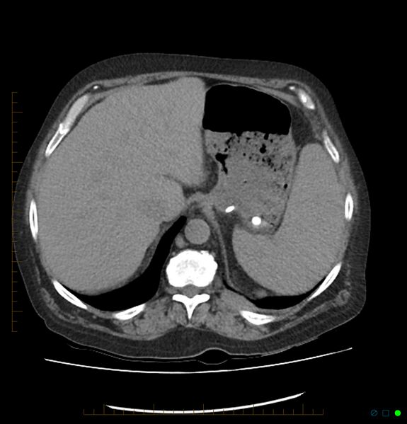 File:Acute renal failure post IV contrast injection- CT findings (Radiopaedia 47815-52557 Axial non-contrast 16).jpg