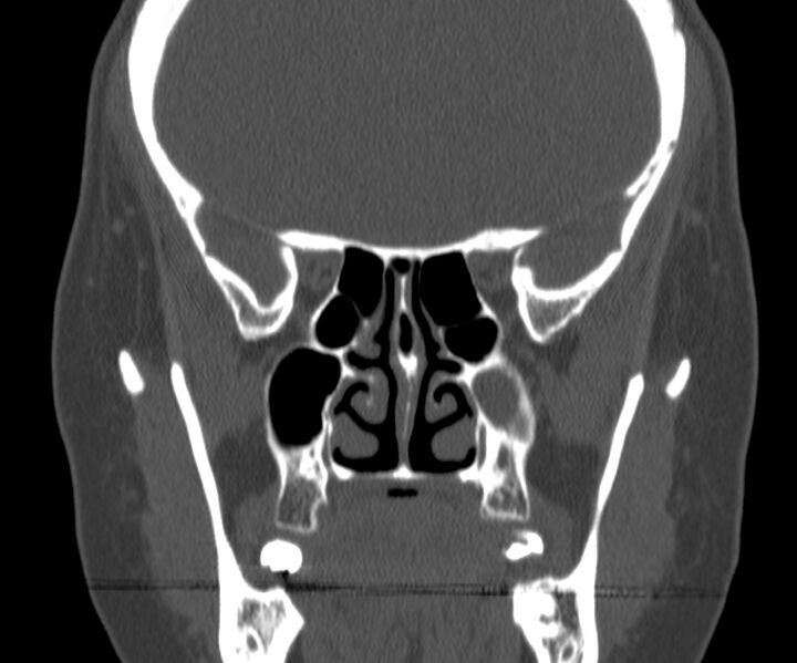 File:Acute sinusitis (Radiopaedia 22419-22455 Coronal bone window 25).jpg