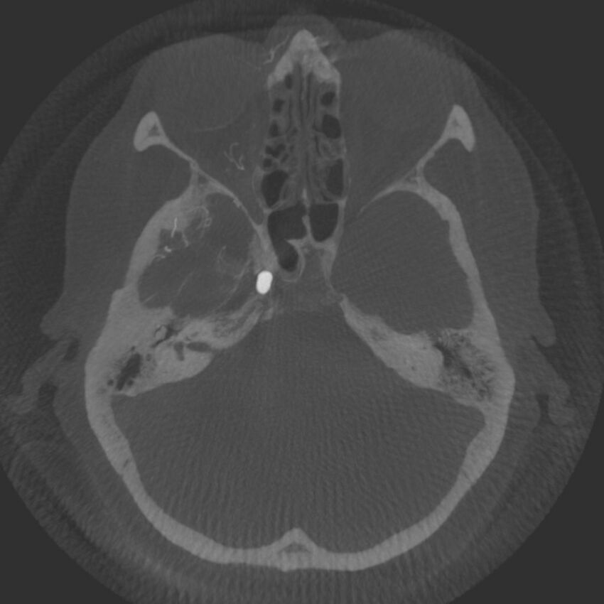 Acute subarachnoid hemorrhage and accessory anterior cerebral artery (Radiopaedia 69231-79010 Axial arterial - MIP 19).jpg