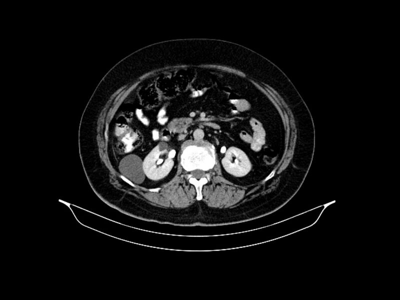 File:Adenocarcinoma of pancreas with hepatic metastasis (Radiopaedia 64332-73122 Axial C+ delayed 45).jpg