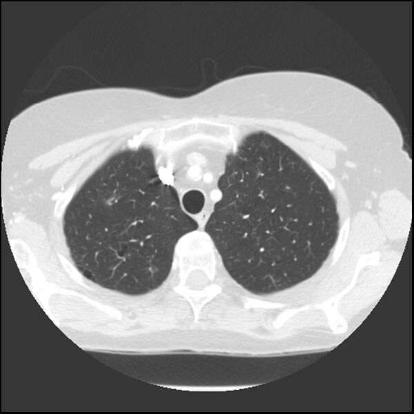 File:Adenocarcinoma of the lung (Radiopaedia 41015-43755 Axial lung window 24).jpg
