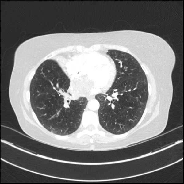 File:Adenocarcinoma of the lung (Radiopaedia 44205-47803 Axial lung window 58).jpg