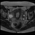 Adenoma malignum of the cervix (Radiopaedia 24460-24765 C 10).jpg