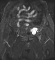 Adnexal multilocular cyst (O-RADS US 3- O-RADS MRI 3) (Radiopaedia 87426-103754 Coronal T2 fat sat 8).jpg