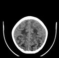 Adrenoleukodystrophy (Radiopaedia 10580-11038 Axial non-contrast 6).jpg